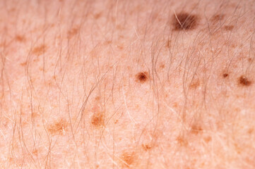 Fototapeta premium Suspicious mole close up on human skin, skin cancer awareness and dermatology concept