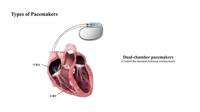 3D Animation of Biventricular Pacemaker Treatment for Heart Failure, Cardiac Care Diagram, Medical Implant Illustration, Ventricular Pacing Technology