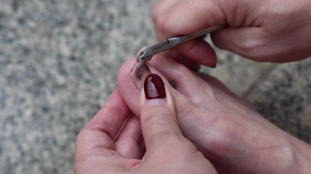 Close up footage of trimming a bruised toenail with nail clippers. Macro details of foot care, nail grooming, hygiene, and damaged toenail maintenance with dark discoloration