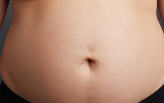 Woman lower belly shows loose skin and visible stretch marks post-pregnancy. Focus on abdomen area, representing body changes after childbirth and weight concerns. Studio shot.