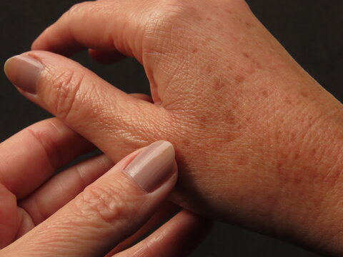 Closeup of woman hand with dark spots on black background. Hyperpigmentation on a woman in her forties hands.