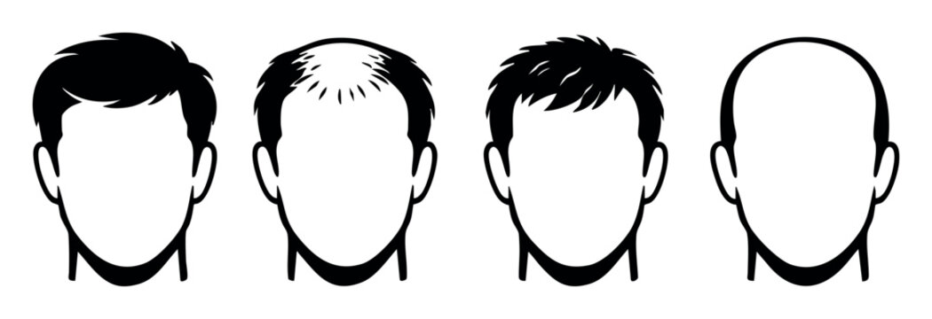 Male balding process stages displaying different levels of hair loss, including male pattern baldness and new hair growth