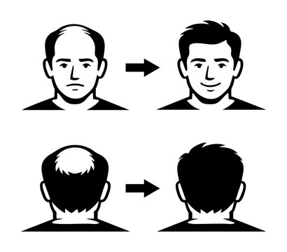 Illustration of a man with baldness problem and thick healthy hair after treatment. Conceptualizing hair regrowth and transplantation
