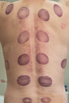Male back with hematomas marks after taking cupping therapy. After vacuum cans