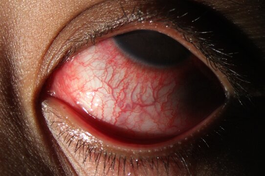 Anterior segment slit lamp photograph revealing conjunctival hyperemia, ciliary flush, and tortuous blood vessels
