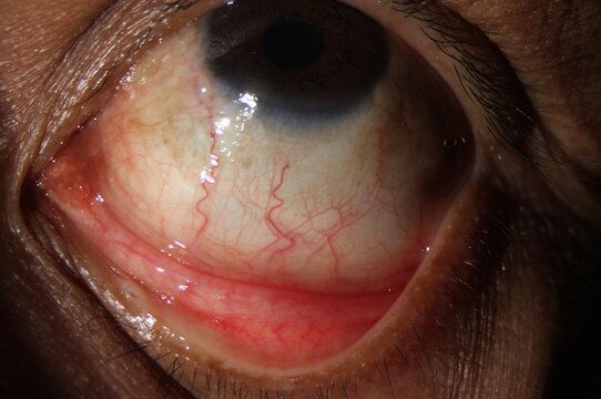 Anterior segment slit lamp photograph revealing prominent conjunctival injection and enlarged episcleral vessels.