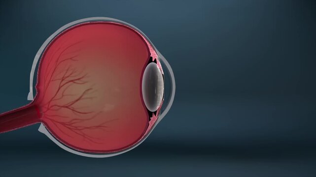 Light passes through the lens into the eye, but age-related cataract makes the lens cloudy, scattering light and blurring vision. 3D animation of cataract pathogenesis.
