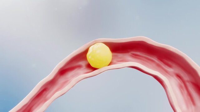 Ectopic pregnancy: the fertilized egg grows in the fallopian tube, eventually rupturing it and causing severe internal bleeding. 3D medical animation of tubal rupture.