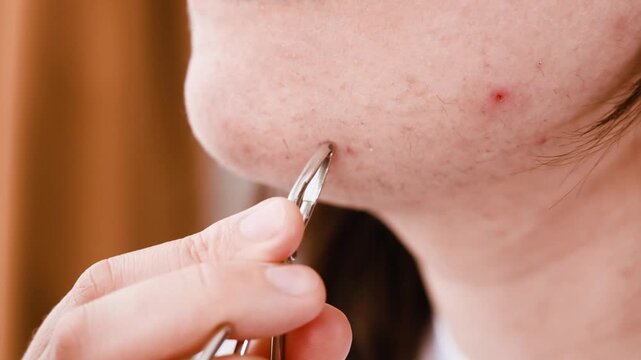 Extreme close-up of a woman using tweezers for chin hair removal. A home beauty routine addressing unwanted facial hair problems caused by hormonal changes. High quality FullHD footage