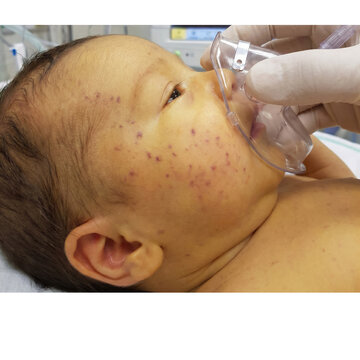 Medical professional administers oxygen mask to a distressed infant exhibiting noticeable skin blemishes and discomfort showing Cytomegalovirus 