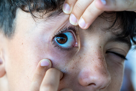 Close-up of a human eye being held open by fingers, revealing redness in the conjunctiva
