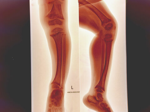 X-ray of human leg. Suggestive of Rickets. 