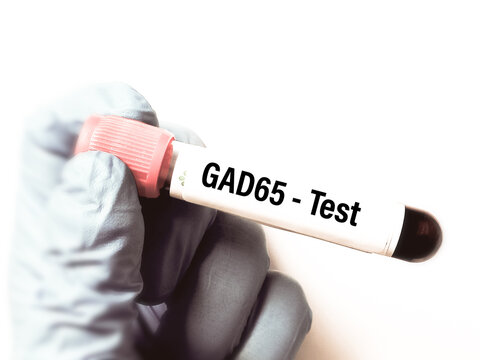Hand holding Glutamic Acid Decarboxylase (GAD65) test tube. Blood sample for Glutamic Acid Decarboxylase (GAD65) Antibody Assay blood test. 