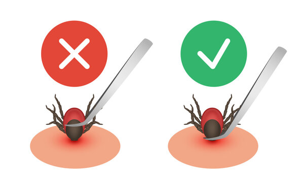 Tick removal with tweezers. Correct and incorrect tick removal. Vector 3D illustration.