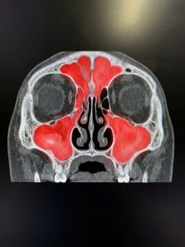 Medical Imaging of Sinuses and Nasal Passages in a CT Scan for Diagnostic Analysis