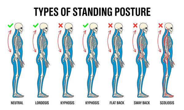 Human standing posture types and spinal alignment diagram with alignment