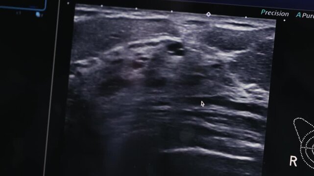 Breast ultrasound, mammogram image on screen in the doctor's office. Health concept and check up examination. High quality 4k footage