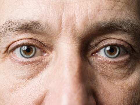 Un dettaglio ravvicinato degli occhi di un uomo adulto affetto da ipercolesterolemia, intorno all'iride &egrave; visibile un leggero anello grigio-biancastro che mostra il segno tipico dei depositi di lipidi
