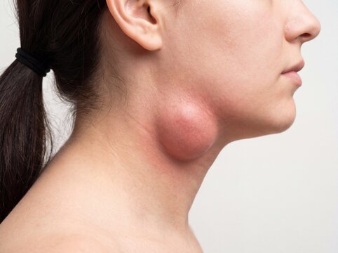 Un dettaglio del profilo del collo di una ragazza colpita da linfadenite acuta, sotto la linea della mascella &egrave; ben visibile un rigonfiamento tondeggiante e arrossato grande come una grossa noce, foto