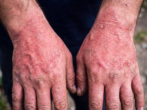 Un primo piano delle mani di un operaio affetto da dermatite da contatto, il dorso delle mani e i polsi mostrano una chiazza rossa vivida e ruvida che ricalca la forma del guanto che ha scatenato la r