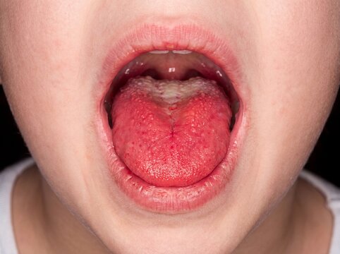 Un primo piano ravvicinato della bocca aperta di un bambino affetto da scarlattina, la lingua &egrave; di un colore rosso brillante e presenta piccoli rilievi mostrando il tipico aspetto a fragola, fotografi