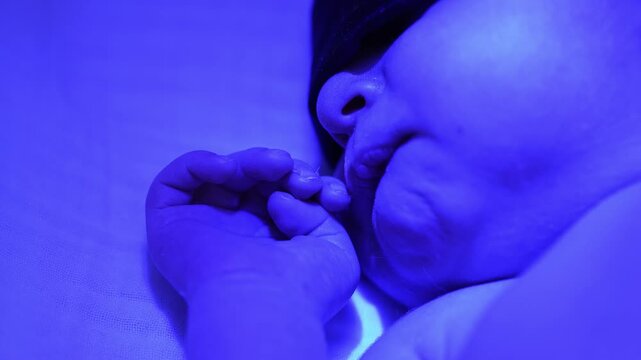 Newborn infant with jaundice sleeping while undergoing phototherapy treatment, bathed in the blue ultraviolet light of a bili lamp to reduce high bilirubin levels in a hospital setting