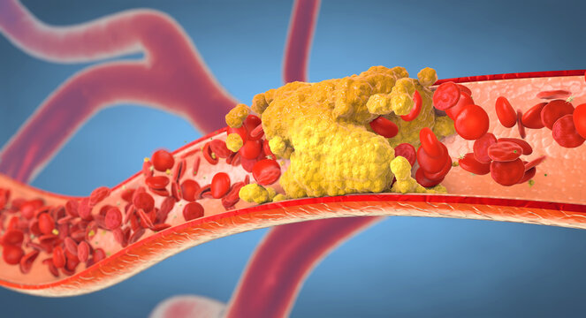 Atherosclerosis is a condition where arteries become narrowed and blocked by fatty plaque buildup. This reduces blood flow and can lead to serious heart and circulation problems.