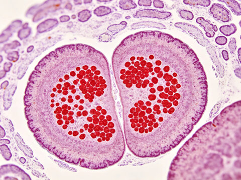 Micrograph of Wright-Gymsa stained blood smear showing human eosinophils with characteristic bilobed nuclei and bright red granules, clinical hematological staining, natural blood smear.