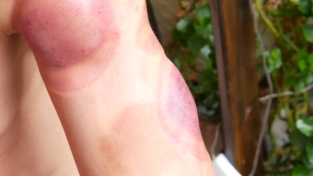 Bruised skin on arm of woman showing marks from cupping therapy. Alternative medicine procedure for muscle recovery. Traditional healing technique on human body.