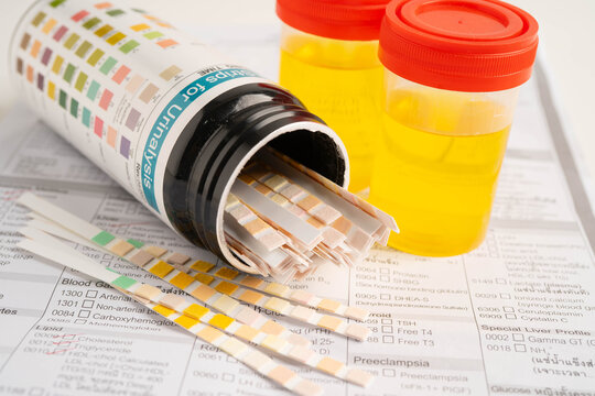 Urinalysis, urine cup with reagent strip pH paper test and comparison chart in laboratory.