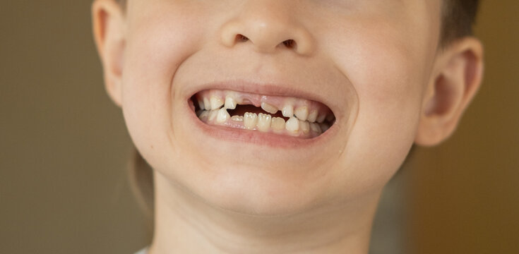 A cheerful child proudly showing a missing upper milk tooth. Concept of childhood growth, dental development, and family moments. Perfect for pediatric dentistry, tooth loss. 