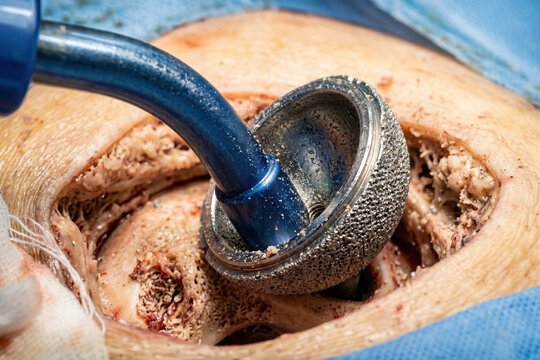 Close-up of acetabular cup insertion during total hip replacement surgery