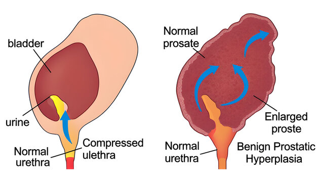 Benign prostatic hyperplasia bph and urinary system anatomy