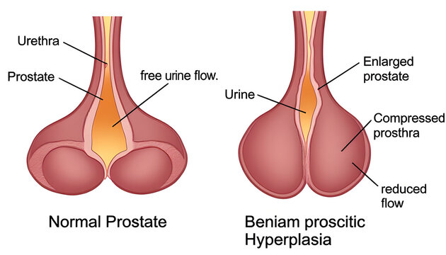 Prostate gland comparison normal vs benign prostatic hyperplasia