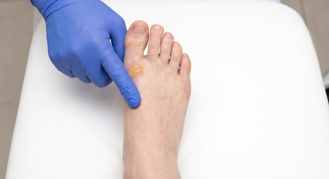 Podiatrist examining foot callus in medical clinic