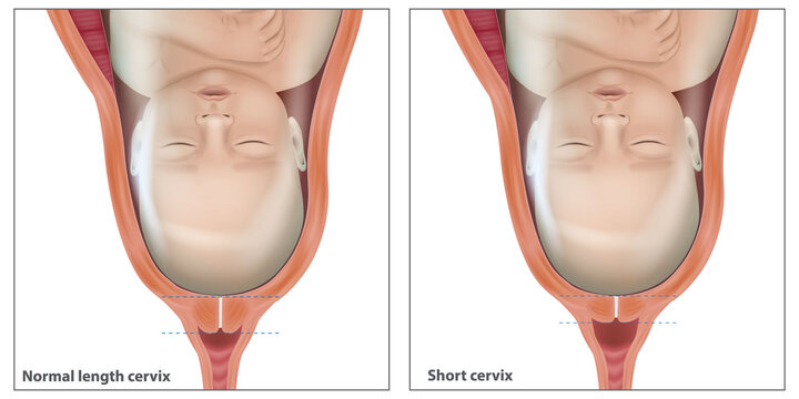Medical Illustration of Normal and Short Cervix During Pregnancy With Fetal Head Presentation. Prenatal Medical Infographic of Cervical Insufficiency and Shortened Cervix During Late Pregnancy
