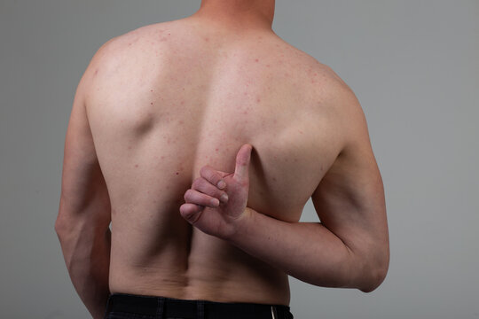 The young man's back is covered with pimples and irritations. Concept: skin diseases caused by the use of chemicals, malnutrition and stress at work. Treatment of acne in adolescents