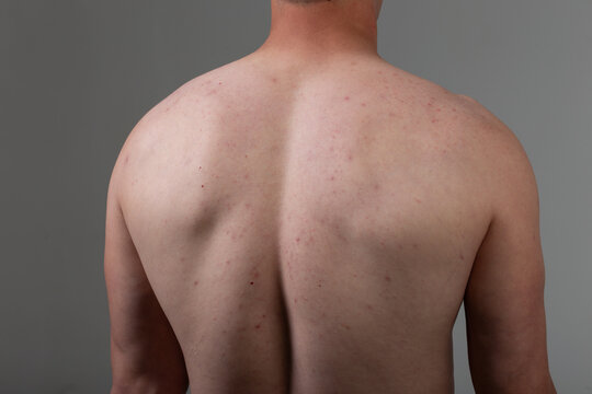 The young man's back is covered with pimples and irritations. Concept: skin diseases caused by the use of chemicals, malnutrition and stress at work. Treatment of acne in adolescents