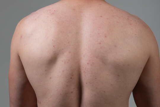 The young man's back is covered with pimples and irritations. Concept: skin diseases caused by the use of chemicals, malnutrition and stress at work. Treatment of acne in adolescents