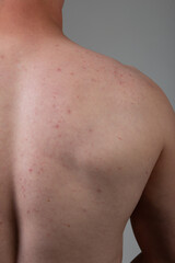 Naklejka premium The young man's back is covered with pimples and irritations. Concept: skin diseases caused by the use of chemicals, malnutrition and stress at work. Treatment of acne in adolescents