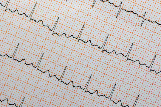 An electrocardiogram (ECG) tracing printed on standard grid paper