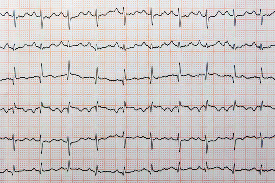 A multi-lead electrocardiogram (ECG) rhythm strip with a highly irregular, rapid, characteristic of conditions like atrial fibrillation or multifocal atrial tachycardia