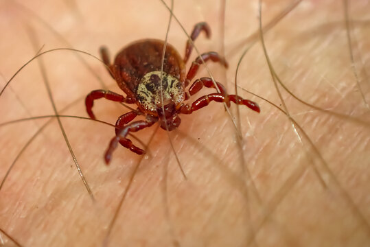 Macro close-up of a tick crawling on human skin. Detailed view of a blood-feeding parasite and vector of tick-borne diseases such as Lyme disease and tick-borne encephalitis