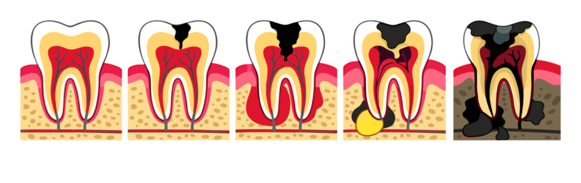 Dental cavity evolution stages featuring a healthy tooth to severe decay, illustrating root infection and enamel destruction