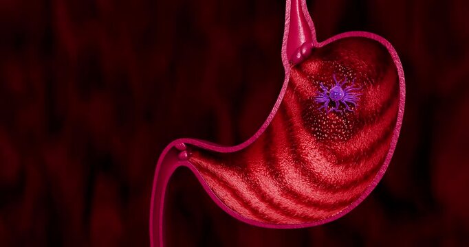 Gastric Cancer Growing Inside Human Stomach Tissue Causing Malignant Tumor Development and Digestive System Damage 3D Rendering
