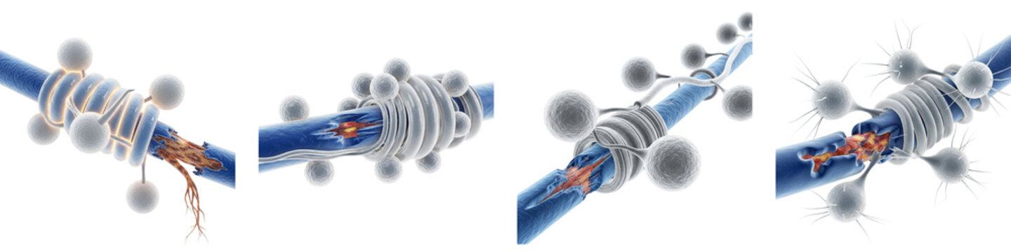 3D rendered medical illustration showing damaged nerves with degeneration