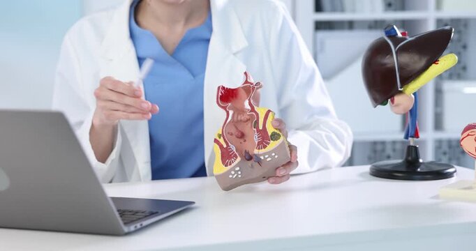 Doctor showing model of unhealthy lower rectum with inflamed vascular structures near laptop at white table in clinic, closeup