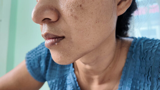 Adult woman face skin hyperpigmentation melasma blemish close up side view cheek skincare concern, adult woman with facial hyperpigmentation and melasma, close up side view showing cheek blemish
