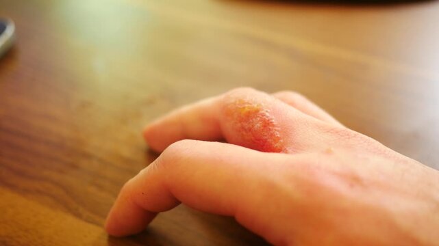 Poison Ivy Rash Oozing Out From Mans Hand - ALT