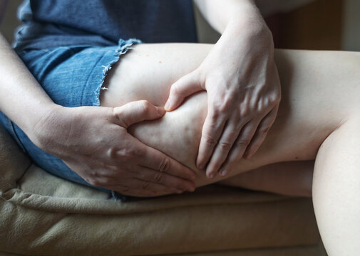 Close-up of a woman squeezing skin on her thigh, showing cellulite texture and orange peel effect. Concept of body aesthetic, female lipodystrophy, skin imperfections, and self-acceptance